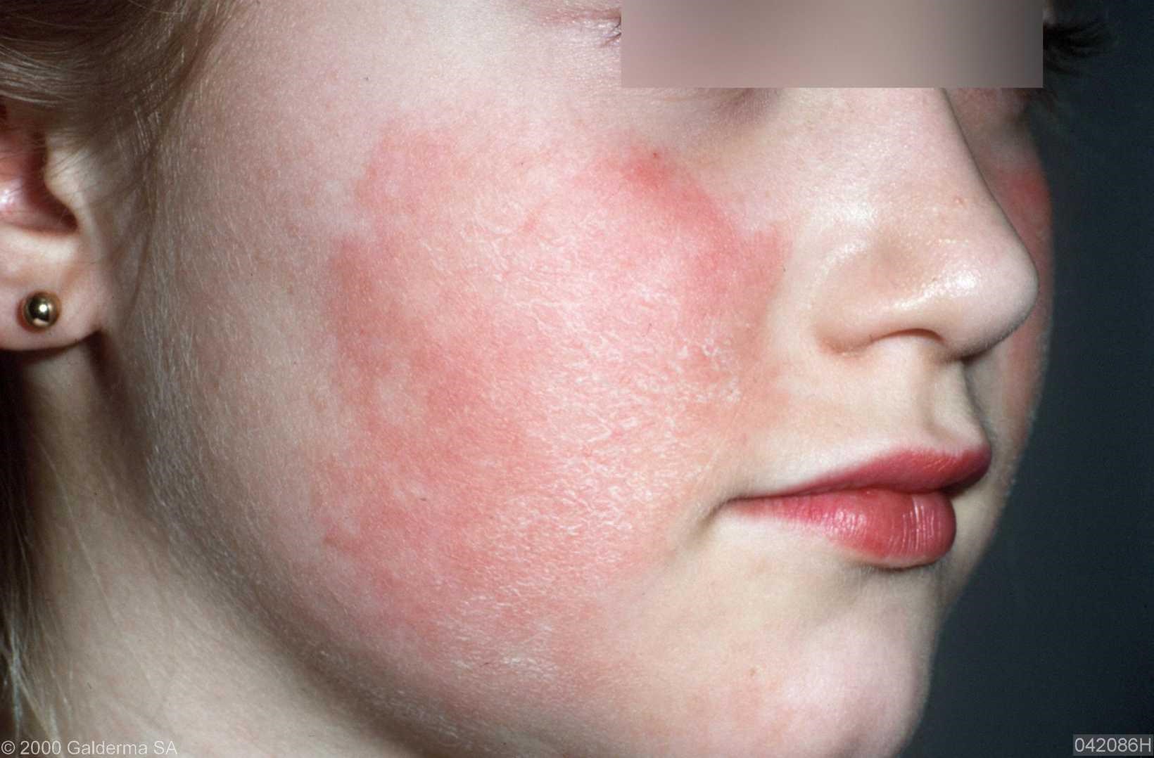 Viral Rashes What You Need To Know Dimensional Dermatology