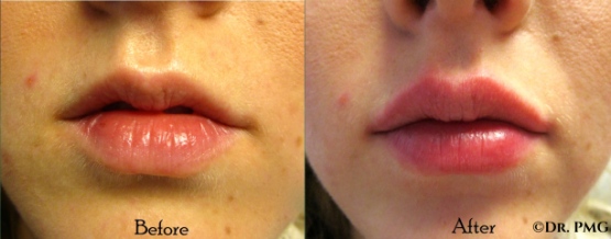 before-and-after-lip.jpg